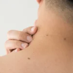 Effective Skin Tag Removal London: Smooth, Blemish-Free Skin