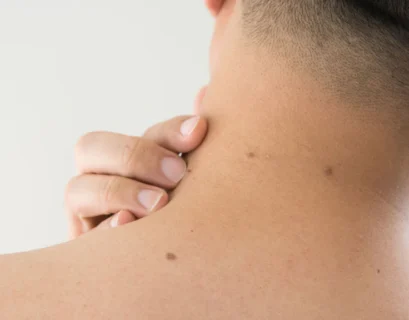 Effective Skin Tag Removal London: Smooth, Blemish-Free Skin